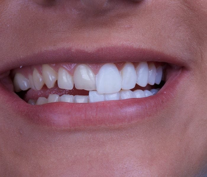 Veneers Cost Per Tooth Dental Implants Houston