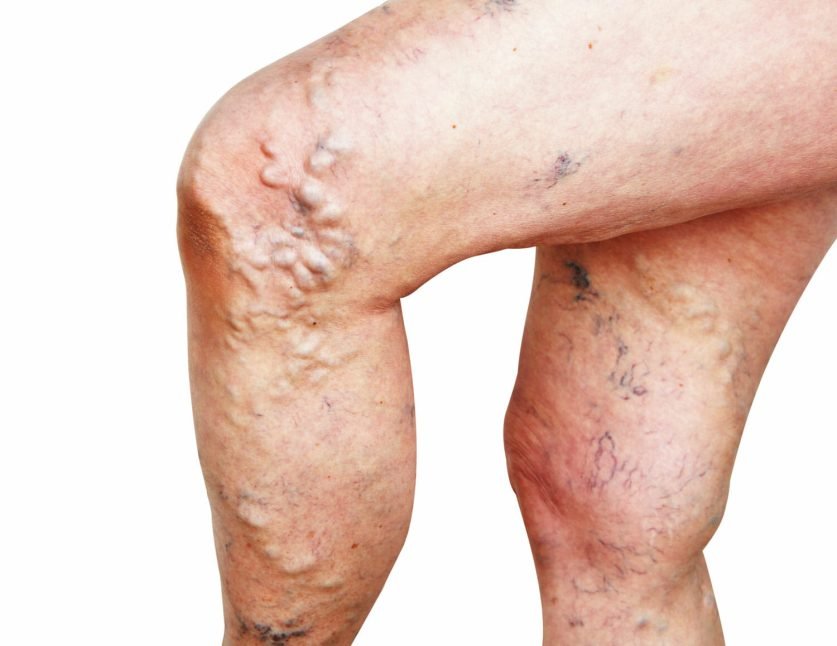 Does Insurance Cover Varicose Vein Treatment Transits Blog