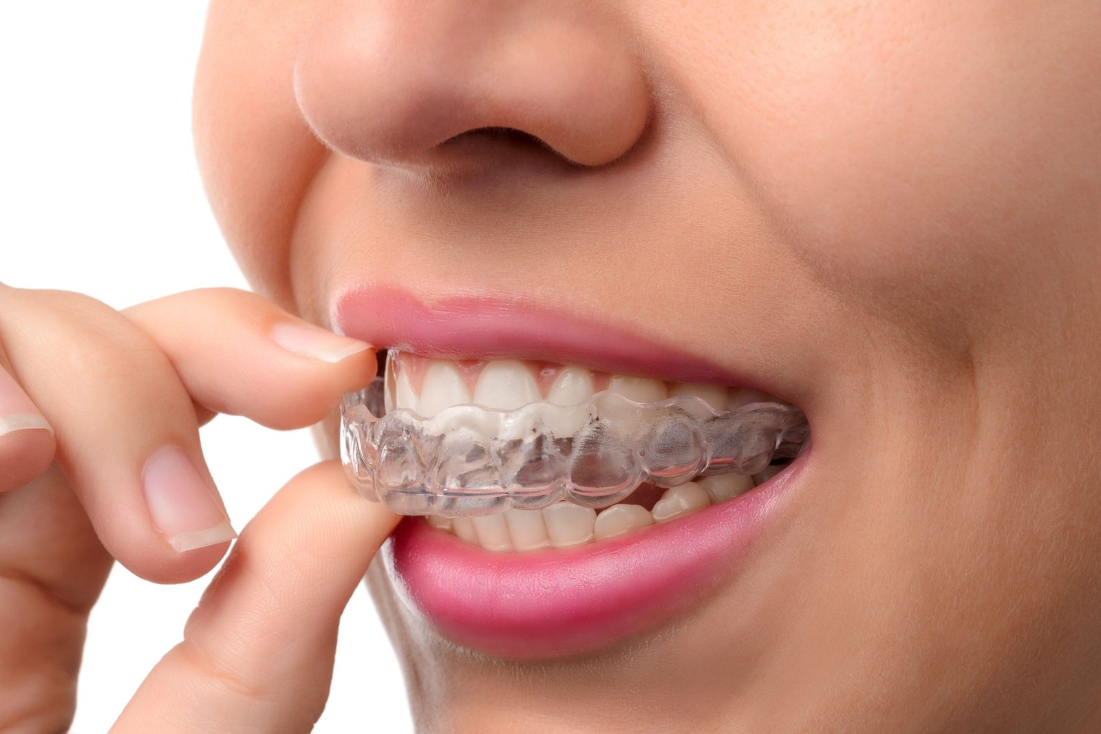 What Do Lingual Braces Explain Transits Blog