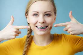 What Are The Most Popular Braces Color In 2023 - Transits Blog