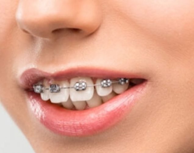 how to fix overbite how to fix overbite